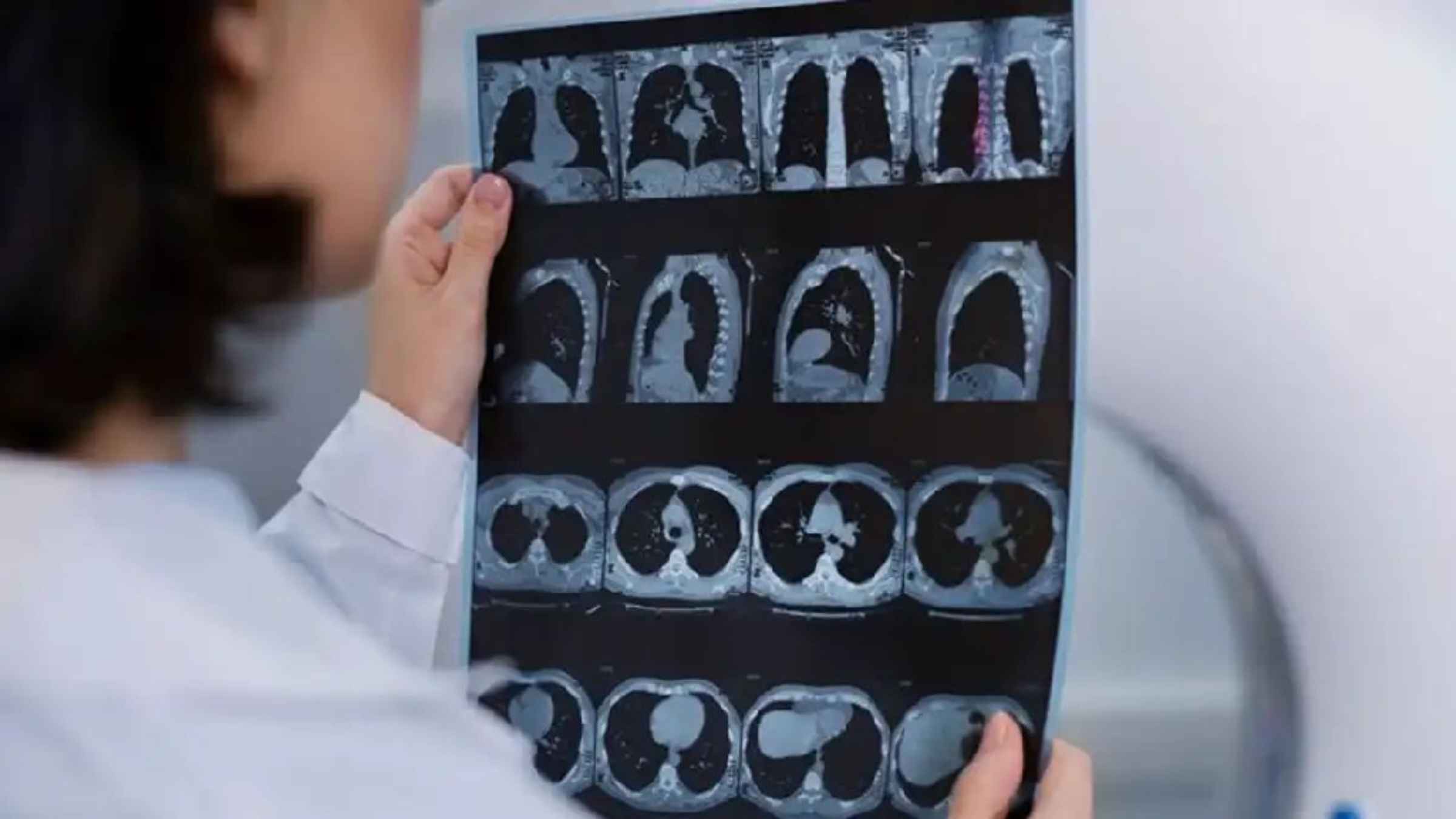 CT Scan Radiation