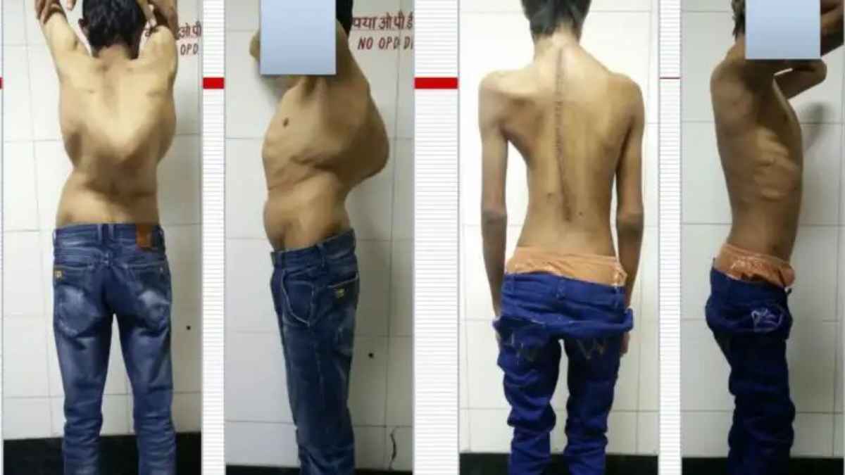 एम्स दिल्ली का कमाल: अब टेढ़ी रीढ़ की हड्डी होगी बिल्कुल सीधी, नई सर्जिकल तकनीक से दुनिया हैरान SpineSurgery